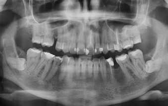 Arquivos mandíbula estalando - VeitSmile