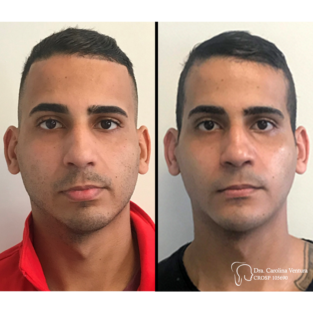 Antes e Depois - Matheus 1