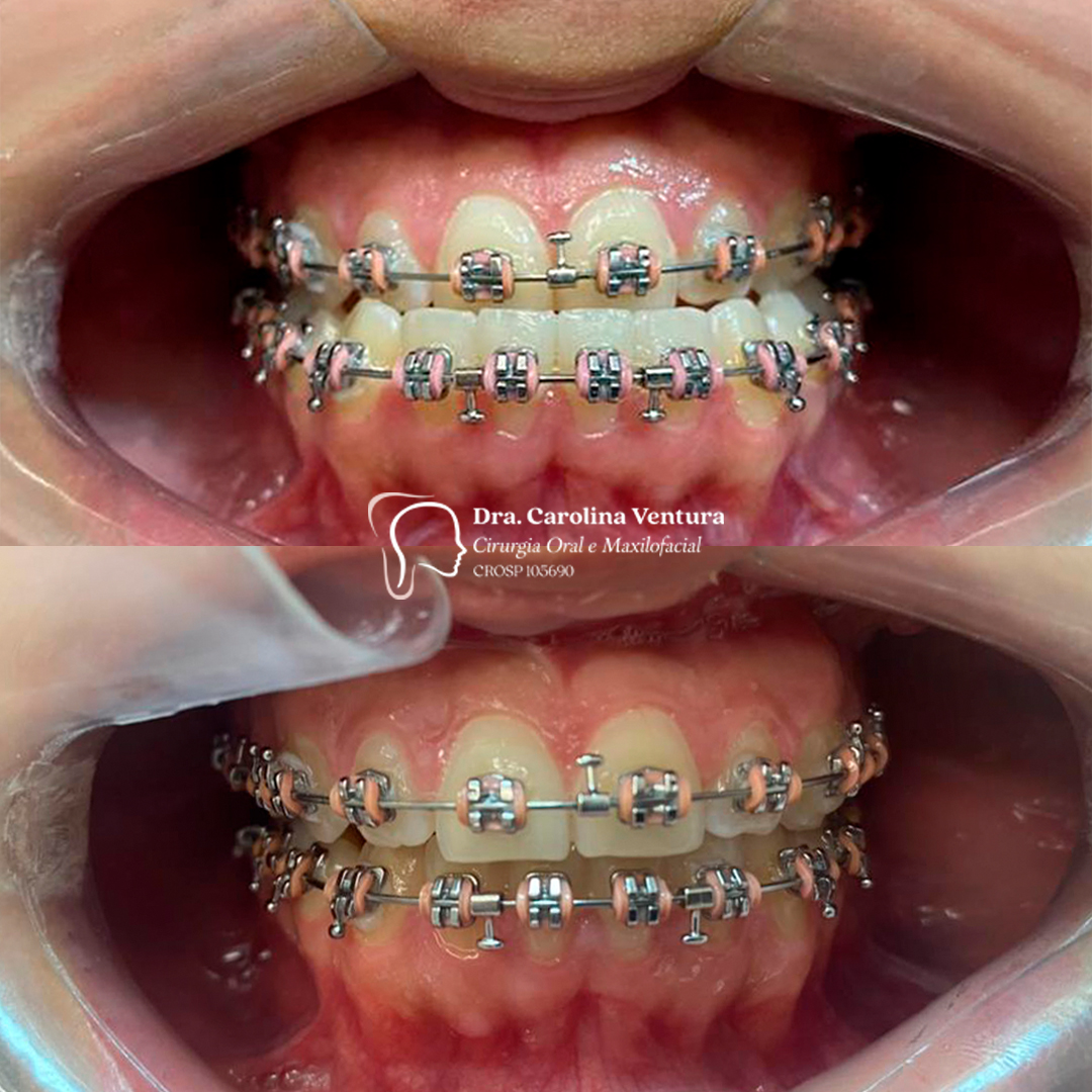 Ortodontia e Cirurgia Ortognática - Dra. Carolina Ventura
